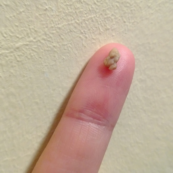 Arquivo:Removing tonsil stones 710.jpg